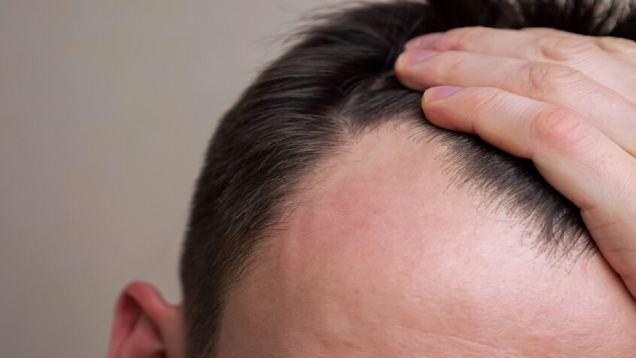 ارتباط برخی از داروهای کاهش وزن با ریزش مو
